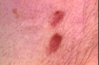 カポジ肉腫画像 カポジ肉腫画像